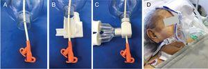 Therapeutic use of tube adaptor for NIMV with one tube. (A) The tube for enteral feeding is passed through the central hole of the mask. (B) The tube adaptor for non-invasive mechanical ventilation is opened. (C) The tube adaptor for non-invasive mechanical ventilation closed around the tube, inserted in the mask and attached to the ventilator circuit. (D) The use of a tube adaptor for one tube for enteral feeding during non-invasive mechanical ventilation therapy in a representative patient.