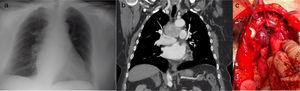 a) Imagen de la masa mediastínica en la radiografía de tórax. b) Imagen de la TC torácica en la que se visualiza la masa en mediastino medio. c) Imagen del paraganglioma durante la intervención quirúrgica en el centro de la imagen. La tráquea se sitúa en su parte superior y la vena innominada superior a esta. A la derecha se encuentra la arteria aorta y en la parte inferior el tronco arterial pulmonar.