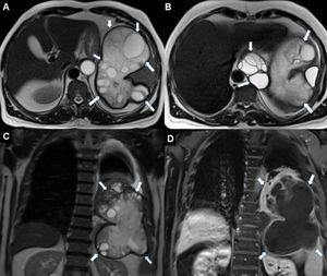 Axial T2-weighted MRI (A and B, respectively) show transdiaphragmatic lesion at the spleen level and multiloculated cystic lesion (arrows) with mediastinal extension at the level of esophageal hiatus. The presence of daughter vesicles in the cysts and the presence of relatively hypointense thick walls are typical features of the hydatid cyst. In the coronal T2-weighted (C) MR image, the cystic lesion (arrows) substantially fills the left hemithorax. The coronal image also reveals minimal pleural effusion. Postcontrast coronal T1-weighted (D) MR image reveals contrast enhancement (arrows) at the lesion's periphery. Moreover, the left lower lung is seen compressed by the cyst.