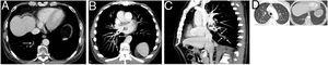 A) Imagen axial de la TC de tórax en la que se observa una opacidad tubular en el segmento posterobasal del lóbulo inferior derecho que corresponde a un defecto de repleción expansivo en la vena pulmonar de dicho segmento (flecha). B y C) Reconstrucciones coronal oblicua (B) y sagital (C) de la TC de tórax (imágenes de proyección de intensidad máxima) en las que se identifica mejor la continuidad de la vena trombosada (flecha), con la vena pulmonar inferior derecha (asterisco) y la aurícula izquierda (AI). D) Imágenes axiales de la TC de tórax (ventana de parénquima pulmonar a nivel del cayado aórtico y de las bases) en las que se observan pequeñas opacidades parenquimatosas bilaterales (flechas).