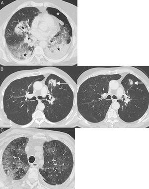 Ejemplos de neumonitis (toxicidad pulmonar). A) Paciente de 64 años con cáncer de pulmón metastásico en tratamiento con inmunoterapia (nivolumab) en el que se observa la aparición en una TC de consolidaciones peribronquiales bilaterales (asteriscos negros). En este caso, se decidió realizar una biopsia pulmonar con aguja gruesa de una consolidación dominante en lóbulo inferior izquierdo, la cual demostró focos de neumonía organizada y ausencia de células tumorales; la biopsia se complicó con un neumotórax izquierdo (asterisco blanco). B) Paciente de 68 años con cáncer de pulmón localmente avanzado en tratamiento adyuvante con inmunoterapia (nivolumab); la imagen de la izquierda muestra la aparición en una TC de una lesión (flecha) con broncograma aéreo en pulmón izquierdo. En este caso se decidió tratamiento empírico con corticoides sistémicos y repetición de TC de tórax en 4 semanas (imagen de la derecha), en la que se confirmó una resolución parcial de la opacidad pulmonar (flecha). El patrón radiológico sugirió una neumonía organizada. C) Paciente de 76 años con cáncer de pulmón metastásico en tratamiento con inmunoterapia (pembrolizumab) que consultó en Urgencias por disnea. La TC de tórax mostró extensas opacidades bilaterales de atenuación en vidrio deslustrado (patrón de neumonitis intersticial no específica). El paciente mejoró tras la suspensión de la inmunoterapia y la administración de corticoides sistémicos.