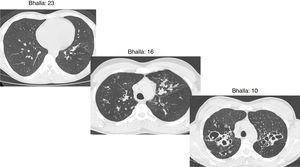 Axial CT images of pulmonary window in different patients with CF and different Bhalla scores. Bhalla 23 is an example of a mild disease with mild bronchiectasis while Bhalla 16 presents a moderate disease with mucous plugging and bigger bronchiectasis. Finally, Bhalla 10 shows a severe disease with sacculations, greater thickness wall and higher luminal diameter of bronchiectasis, also with mucous plugging and air trapping.