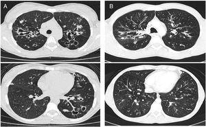 CT images comparison between male and female with the same FEV1: (A) 35 year-old female. Severe bronchiectasis on upper lobes (scored 3), mild peribronchial thickening (scored 1), peripheral mucus plugs are present on upper lobes (scored 2), sacculations are present on left lower lobe. Sparing of distal peripheral zones is detected. Total Bhalla score: 10. FEV1 60%. (B) 40 year-old male. Moderate bronchiectasis (scored 2), mild peribronchial thickening (scored 1), mucus plugging (scored 2) was present on upper lobes. Sparing of distal peripheral zones is detected. Total Bhalla score: 17. FEV1 60%.