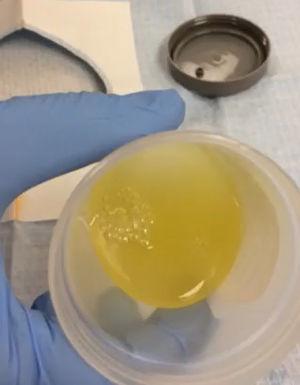 Supplementary video file. Pleural effusion is thick and yellow as it is poured into the specimen cup. The fluid has thixotropic properties where it stable at rest but appears to become more fluid when agitated. Limited pleural fluid analysis revealed an elevated total protein of 3.1, cell count of 950 WBCS with 1 neutrophil, 98 mononculear and 1 other. Cultures were negative. Cytology reveals rare atypical cells in a background of abundant mucoid material.