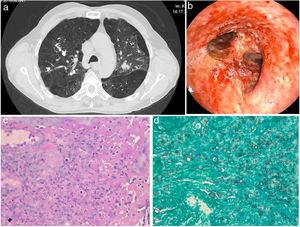 Computed tomographic image of the patient thorax (a) and endobronchial aspects of disease at the distal third of patient's trachea (b); Histochemical detection of fungal forms in PAS coloration (c) and Grocott coloration (d).