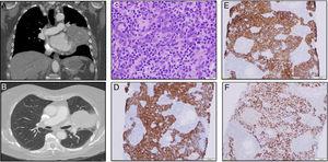 (A, B) 6.4cm heterogenous mass replacing the lingula with large endobronchial component. (C) Hematoxylin and eosin-stained section of lung (400×). (D) Tumor cells with positive CK5/6 staining (100×). (E) Neoplastic cells with positive staining for pancytokeratin AE1/AE3 (100×). (F) Neoplastic cells P40 positive (100×).