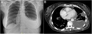 A) Radiografía de tórax mostrando derrame pleural izquierdo. B) Tomografía axial computarizada (ventana mediastínica) mostrando derrame pleural libre y organizado izquierdo.