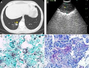 (A) Computed tomography of chest reveals new cavitary nodules in the right lower lung. The right lower lung cavitary lesion (yellow arrow) is adjacent to a bronchus (yellow carrot). (B) Convex-probe endobronchial ultrasound image of thickened cavitary wall (yellow asterisk) of right lower lobe opacity. (C) Gomori Methenamine-Silver nitrate statin (A, 600×) highlights the branching gram-positive filamentous organisms. (D) Nocardia is weakly acid-fast, and FITE (B, 600×) stain, which is a modified acid fast stain, is positive with the branching filamentous organism.