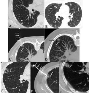 Pacientes 1 (A-D) y 2 (E-G). Todas las imágenes corresponden a cortes axiales de TC de tórax (ventana de parénquima pulmonar). A) Imagen que muestra un nódulo subsólido mixto subpleural (flecha) en lóbulo inferior derecho. B) Imagen en la que se identifican varias opacidades subpleurales bilaterales de atenuación en vidrio deslustrado (flechas) compatibles con un patrón de neumonitis intersticial descamativa. C) Imagen con la paciente en posición de decúbito prono, en la que se observa el trocar (flechas blancas rectas) atravesando la pared torácica, una localización aparentemente intrapulmonar del extremo distal del trocar (flecha negra) y el nódulo pulmonar (flecha blanca curva). D) Imagen con la paciente en decúbito prono tras la retirada del trocar en la que se identifica una localización extrapulmonar de la semilla de I-125 (flecha negra) y el nódulo pulmonar (flecha blanca curva). E) Imagen que muestra un nódulo subsólido cavitado subpleural (flecha) en lóbulo superior derecho. F) Imagen en la que se observa el trocar (flechas blancas rectas) atravesando la pared torácica, una localización aparentemente intrapulmonar del extremo distal del trocar (flecha negra) y el nódulo pulmonar (flecha blanca curva). Nótese la aparición de un pequeño neumotórax laminar (asteriscos). G) Imagen tras la retirada del trocar en la que se identifica una localización extrapulmonar de la semilla de I-125 (flecha negra) y un pequeño foco de hemorragia subpleural (flecha blanca curva).