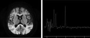 Izquierda: Resonancia magnética (RM) cerebral. Secuencia de difusión, corte axial. Se aprecia hiperseñal difusa de la sustancia blanca. Derecha: Espectroscopia de RM cerebral. Pico de glicina en sustancia blanca parietal derecha.