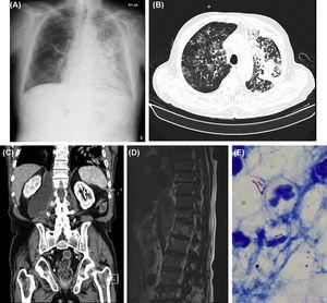 (A) Chest X-ray (posteroanterior [PA]): Right reticulomicronodular pattern and left lung cephalocaudal infiltrates; (B) Chest CT (axial plan [AP]): Bilateral micronodular opacities, right ground-glass opacities and extensive left consolidation areas; (C) Abdomen CT (coronal plan [CP]): Right retroperitoneal and retrocrural collection measuring 9×5.5cm, with inferior extension to L5 and bone destruction of the right lateral slope of D12; (D) Dorsolumbar spine MRI (sagittal plan [SP]): Signal heterogeneity suggestive of lytic and blastic lesions of D12 with cortical disruption, paravertebral soft tissue mass and enlargement of the psoas muscle; (E) Acid Fast Bacilli in the fluid drained from the psoas abscess, Ziehl-Neelsen.