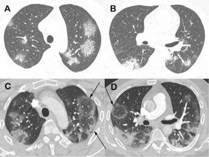 Chest computed tomography images of a 48-year-old man with confirmed COVID-19 pneumonia. Images obtained at the levels of the upper (A) and lower (B) lobes 2 days after symptom onset show bilateral round and oval ground-glass opacities. Enhanced images (C and D) obtained at the same levels as A and B 3 days later show multiple reversed halo signs (arrows) in both lungs.