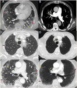 (A) Transverse CTPA images obtained with lung window setting shows multiple pulmonary parenchymal mainly peripheral ground glass opacities (red arrows). Bilateral varicose bronchiectasis (yellow arrows). (B) Maximum intensity projection (MIP) reconstructions images in axial plane shows filling defects (green circle) at the bifurcation level of the anterior segmental branch in right upper lobe compatible with pulmonary thromboembolism. (C–F) Transverse CT images with lung window (C and E) and reformatted Minimum intensity projection (MinIP) reconstructions (D and F) obtained at upper and medium mediastinic levels shows pulmonary interstitial emphysema with air tracking along the right peribronchovascular sheaths ((blue arrows). Central upper anterior right pneumomediastinum (green circles) secondary to a spontaneous barotrauma (Macklin effect). Multiple parenchymal ground glass opacities with prevalent peripheral distribution (red arrows). Bilateral varicose bronchiectasis (yellow arrows).