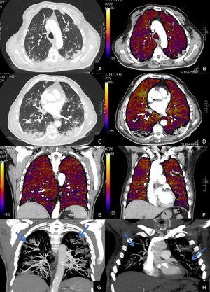 Paciente con COVID-19 con insuficiencia respiratoria grave a pesar de mejoría de parámetros inflamatorios. Imágenes axiales de angiografía pulmonar con TC y mapa de yodo, con ventana de pulmón (A, C) en cayado y lóbulos inferiores y su correlación con las imágenes del mapa de yodo axial (B, D), coronales (E, F) y reconstrucción MIP coronal en ventana de mediastino (G, H). Parénquima con moderada afectación parenquimatosa, con consolidaciones subpleurales parcheadas de predominio en lóbulos inferiores y extensas áreas de hipoperfusión (azules) parcheadas de predominio subpleural en el mapa de yodo, que se correlacionan con la falta de relleno del territorio vascular distal en el MIP coronal (flechas azules), sin TEP visible.