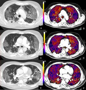 Paciente con COVID-19 que persiste con desaturación a pesar de mejoría clínica. Imágenes axiales de la angiografía pulmonar con TC y mapa de yodo con ventana de pulmón (A, C, E) desde cayado hasta lóbulos inferiores y su correlación con las imágenes del mapa de yodo (B, D, F). Parénquima con extensa afectación en vidrio deslustrado de predominio subpleural con consolidación de pequeño tamaño en LID, sin TEP visible, con áreas parcheadas de hipoperfusión (zonas azules) en el mapa de yodo, de predominio periférico, que coinciden con las zonas en vidrio deslustrado.