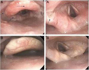 . A. Úlceras (flechas) vistas por broncoscopia flexible. B. Práctica resolución de las lesiones en broncoscopia de control.