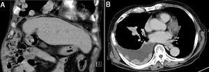 A and B: In A abdominal computed tomography showing no local recurrence over the liver, and in B chest computed tomography showing multiple right pleural masses with moderate pleural effusion.