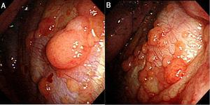 A and B: In A and B pleuroscopy shows multiple cobble-like and protruding pleural masses of different sizes.