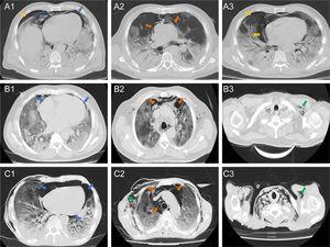Axial tomographic sections of three patients (A, B, and C) with different degrees of gas present at the pericardial level (blue arrows), mediastinal (orange arrows), pleural (yellow arrows) and subcutaneous emphysema (green arrows). A1–3 shows a moderate presence of gas around the cardiac silhouette, large vessels, and right pneumothorax. B1 shows presence of gas in the pericardial sac (mild or laminar). C1–3 shows the severe presence of gas in the pericardium, mediastinum and subcutaneous space.