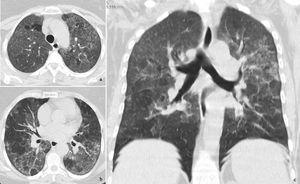 Chest CT axial (a, b) and coronal (c) images demonstrating diffuse bilateral ground-glass opacities with lobular spared areas (mosaic attenuation pattern), ill-defined centrilobular ground-glass nodules in the upper lobes and mild interlobula.
