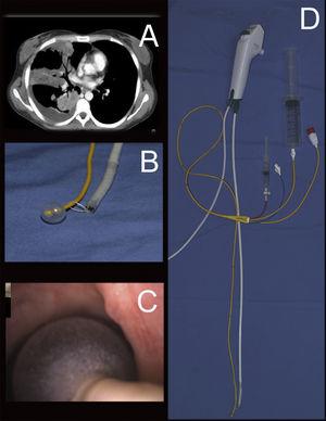 (A) Chest CT scan: cavitary lesions in the lung and right pleural effusion. (B) Surgical linen tie and fastening the balloon with the linen handle. (C) PAC in airways. (D) Complete set with syringe balloon and 60ml syringe.