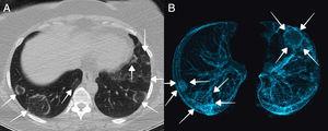 Axial chest CT (A) and axial 3D volume-rendering (B) images revealed bilateral, multilobar peripherally located lesions with “multiple reversed halo sign” (arrows).