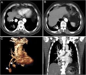Axial contrast-enhanced thorax CT images(A, B) showed two pulmonary aneurysms in the lower lobe of the right lung(Arrows). 3D volumetric reconstruction image(C) showed pulmonary artery connections and aneurysms (Arrowheads). Aneurysm(Asterisk) in the lower lobe of the right lung were observed in the thorax CT lung mediastinal window(D).