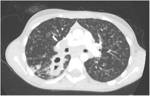 Thoracic computed tomodensitometry: disseminated tuberculosis.
