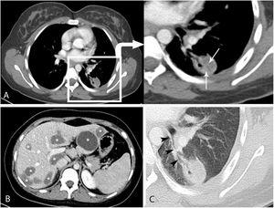 Contrast-enhanced axial computed tomography (A) showed a heterogeneous nodule in the lower lobe of the left lung with air bubbles and internal germinative membranes (arrows). There was an increase in cyst density due to germinative membranes. Computed tomography (B) showed multiple well circumscribed hypodens hydatid cystic lesions in the liver (Asterisks). Computed tomography, lung window(C) showed the communication between the cyst and a bronchus (arrowheads).
