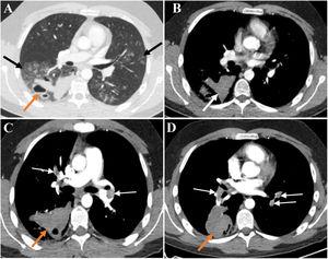 (A) Late arterial phase chest CT depicts bilateral peribronchovascular groundglass opacities (GGO), especially in the right lower lobe (black arrows). In the right lower lobe thick-walled cavitary lesions with air-blood levels are also seen (orange arrow). The high density of blood-containing cavities is illustrated in B (white arrow). The GGO translate diffuse alveolar haemorrhage and the cavitary lesions result from the spontaneous rupture of the lung. There was no evidence of haemothorax or pneumothorax.(C and D) CT pulmonary angiographic study shows bilateral pulmonary thromboembolism (white arrows) and enlarged haemorrhagic cavity in the right lower lobe (orange arrows). No signs of pulmonary hypertension or right ventricular strain were present.