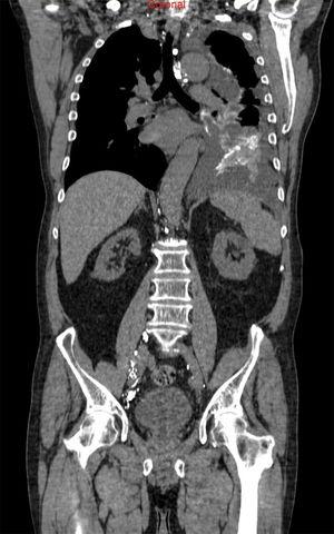 Corte coronal de una tomografía computarizada donde se observa el lipiodol inyectado durante una linfangiografía intranodal en los conductos linfáticos inguinales, conducto torácico y cavidad pleural izquierda.
