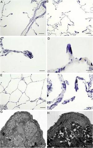 Localization of elastic fibres in lung samples from COPD patients and control subjects. Verhoeff's staining of elastic fibres in alveolar ducts of a healthy control (A) and a COPD patient (B), with arrows indicating accumulation of elastic fibres in collapsing walls of emphysematous areas (bars=100μm). Detail of a tip of an alveolar wall of a control subject (C), showing the normal distribution of elastic fibres, while the alveolar walls of the emphysematous (D) areas appear collapsed in COPD patients (bars=25μm). Micrography of normal lung parenchyma of a control subject (E, bar=100μm) and emphysematous parenchyma of COPD patient (F, bar=50μm), showing prominent elastic accumulations. (G) Electron microscopy of a tip of a normal alveolar wall (bar=500nm). (H) Electron microscopy of a collapsing alveolar wall, showing vacuoles and a pierced pattern in the amorphous component (bar=500nm).