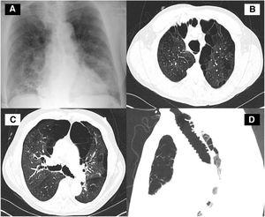 (A) Chest radiograph revealed peripheral opacities in the mid and lower lung zones bilaterally. (B) Thoracic CT at a level above the aortic arch shows tracheomegaly severe bullous paraseptal emphysema. Groundglass opacification and nodular consolidation right middle lobe. (C) Thoracic CT at a level slightly below Carina demonstrated dilated right and left main bronchi with severe bullous paraseptal emphysema. Groundglass opacification and nodular consolidation right middle lobe. (D) CT image of the trachea (sagittal view) showing tracheomegaly.