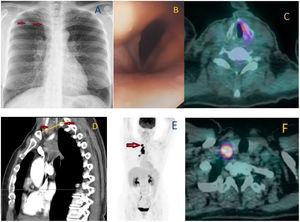 (A) Chest X-ray. Right apical solitary nodule and thickening of the right paratracheal stripe (arrows). (B) Endoscopic view of the larynx reveals RVCP. (C) CT-PET at the larynx. No uptake in the right vocal cord is compensated by hypermetabolism in the left one. (D) Chest CT, sagital view. A lower neck adenopathy (left arrow) lies just above the level of the first rib's (right arrow) trajectory (line). Therefore, it belongs to the 1R nodal station.1 (E) PET scan. Increased uptake of the radiotracer noted at 1R (arrow), 2R, 4R and 10R nodal stations. The lung nodule was also hypermetabolic (not shown). (F) CT-PET reveals hyperactivity in the right juxta thyroid adenopathy (1R).