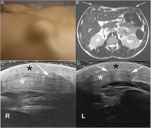 (A) Photograph of the patient's chest, showing a round mass in the right hemithorax, anterior to the lower ribs. (B) T2-weighted magnetic resonance image showing the low signal intensity of the lesions (arrows). Ultrasonography of the lower right (C) and left (D) hemithoraces revealed hypoechoic masses (arrows) with surrounding dermal (black asterisks) and subcutaneous (white asterisks) thickening.