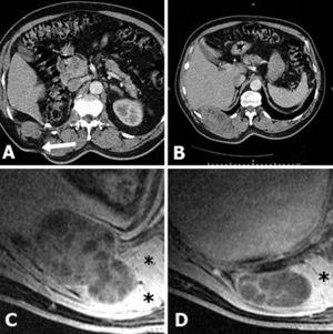 (A, B) CT. Multicystic mass which originates from the lumbotomy scar (arrow). (C, D) Axial fat-suppressed gadolinium-enhanced T1-weighted MRI. Multilocular cystic mass (arrows) extending from the right nephrectomy bed into the posteroinferior thoracic wall and paravertebral muscles (asterisks). Note the hourglass morphology in C.