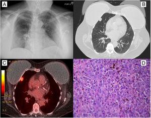 (A) Chest radiography was unremarkable. (B) Computed tomography of the chest demonstrated 1.9cm×1.2cm subpleural right middle lobe lung nodule. (C) F18-fluorodeoxyglucose positron emission tomography scan showed intense uptake in a nodule in the right middle lobe of the lung with no evidence of malignancy aside from the primary lung tumor. (D) Pathology of the resected specimen demonstrated the malignant cells form rounded nodules with thin fibrous rims. There are scattered areas with prominent coarse, brown pigment deposition. Cells are large with variable amounts of pink cytoplasm and form sheets. There are enlarged nuclei with irregular nuclear contours, vesicular chromatin, occasional multinucleation or nuclear inclusions, and some visible nucleoli consistent with melanoma.