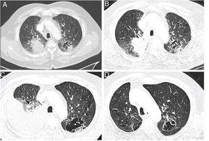 Chest CT-scan images showing the evolution of the patient. (A) Axial contrast section showing an upper right lobe mass (lung adenocarcinoma) and a mixed lesion (cavity and solid) in the upper left lobe (July 27th, 2018). (B) Axial contrast section showing a progression of the upper right lobe mass after chemotherapy; baseline for the start of the immunotherapy (January 18th, 2019). (C) Axial contrast section showing an abundant right pleural effusion (pleural tuberculosis) and previously described mixed lesion in the upper left lobe (April 30th, 2019). (D) Axial contrast section showing an almost complete tumor response after 28 cycles of immunotherapy (March 23rd, 2021).