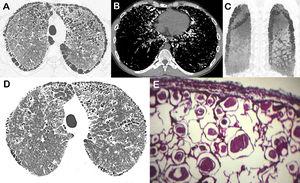 Chest computed tomography axial image obtained with lung window setting (A), mediastinal window setting (B) and coronal (C) reformatted reconstruction using minimum intensity projection (MinIP) showing extensive paraseptal emphysema and pulmonary calcifications predominating in the paramediastinal regions. Note also signs of interstitial emphysema (especially in A). In D, an axial scan with lung window setting obtained 12 years previously demonstrating incipient paraseptal emphysema. In E, a photomicrograph of a pulmonary biopsy specimen showing laminated microliths filling the alveolar spaces (original magnification×100; hematoxylin and eosin stain).