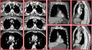 (A, C, and E) Thorax CT scans during presentation demonstrate normal mediastinum structures. (B, D, and F) After three months surgical treatment, control CT scans reveal rebound thymic hyperplasia (asterisks) in the anterior mediastinum.