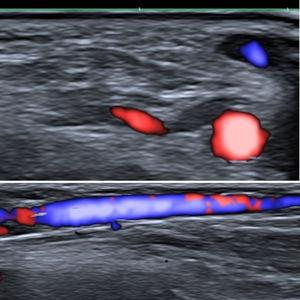 En la imagen superior, ecografía Doppler color en corte axial de la vena cefálica, parcialmente rellena de color azul y de la arteria radial, con color rojo. En la imagen inferior, corte longitudinal de la vena cefálica.