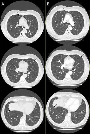 La tomografía computarizada de alta resolución (A) muestra múltiples nódulos pulmonares infracentimétricos (flechas negras) con resolución parcial de los mismos a los 3 meses (B).