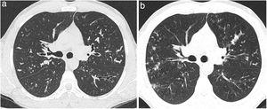 (a, b) Example of the evolution of two consecutive axial CT images (a: CT axial image at the first CT and b: CT axial image at the last CT) of a patient with cystic fibrosis demostrating a progression of mucus plugging. Brody II subscore for mucus plugging at the first CT was 5 and at the last CT was 10. There was also a decline of FEV1% (FEV1% 1 was 79% and FEV1%-2 was 66%). CT: computed tomography. FEV1%-1: forced expiratory volume in 1 second at the first CT time. FEV1%-2: forced expiratory volume in 1 second at the first CT time.