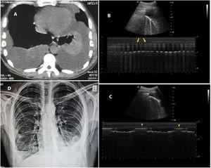 Panel A: chest computed tomography scan showing bilateral partially loculated pleural effusions. Panel B: top half: B-mode image of pleural effusion, underlying consolidated lung and an A-type artefact; bottom half: M-mode image showing rapid and irregular alternation between short runs of barcode sign (yellow arrows) and regions of blackness representing a hydropneumothorax. Panel C: top half: B-mode image of pleural effusion, underlying consolidated lung and an A-type artefact; bottom half: M-mode image showing regular alternation between the seashore sign (yellow arrowheads) with black effusion representing the expanding and receding aerated upper lobe. Panel D: chest radiograph shows right partially loculated hydropneumothorax and left partially loculated pleural effusion.