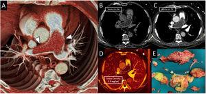 Panel A. Dual-energy CT (DECT) pulmonary angiography. The cinematic rendered reconstruction showed a pulmonary artery filling defect that expanded the arterial wall (arrow). Panels B–D. Virtual non-contrast (Panel B) and blended CT (Panel C) images demonstrated density increase within the lesion, revealing contrast uptake. This was confirmed with the iodine quantification map (Panel D) that showed high iodine concentration in the pulmonary defect (>1mg/ml). Panel E. T1-weighted post-gadolinium cardiac MRI demonstrated subtle enhancement of the pulmonary artery filling defect.