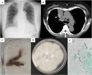 (a) Chest X ray shows tumor-like shadow in the right lower hilum. (b) Chest computed tomography shows high attenuation in the right upper lobe (yellow arrow head). (c) Purulent mucus plug aspirated by bronchoscopy. (d) Woolly, whitish to pale greyish-brown colony of Schizophyllum commune on potato dextrose agar after 7 days of incubation at 25°C. (e) Grocott Gomori Methanamine Silver staining of mucus plug showing fungal hyphae (×400).