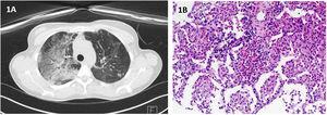 (A) Chest HRCT: multiple ground glass opacities and interlobular septal thickening; (B) Histopathological findings of transthoracic needle biopsy: On hematoxylin and eosin staining there is lung tissue with alevoli filled by histiocytes and eosinophils, forming “eosinophilic microabscesses”. (Original magnification: 100×).