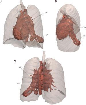 Reconstrucción volumétrica a partir de angio-TC pulmonar con contraste. Se identifica malformación arterio-venosa con arteria pulmonar izquierda (API) de un calibre máximo de 17 mm con ramas arteriales que drenan en la vena pulmonar inferior izquierda (VPI) de 19 mm de calibre máximo proximal. Por otra parte, se identifican 2 sacos vasculares conectados por ramas arteriales y venosas pulmonares de 35×28mm y un saco medial de 27×20mm. A) Visión anterolateral izquierda. B) Visión laterosuperior izquierda. C) Visión posterior.