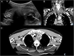 (A) B-mode neck ultrasound showing the thyroid gland (empty arrow) with a cystic lesion containing septations and mobile echoes on the left lobe (thin arrow). (B and C) Cervico-thoracic CT with intravenous contrast in coronal (B) and axial (C) planes. A formation of cystic density is seen on the lower pole of the left thyroid lobe, with intrathoracic extension (fine arrow), causing the trachea (asterisks) and esophagus to shift to the right, with parietal thickening of the trachea (asterisks). Disruption of the wall is observed at the caudal-most margin of the cystic lesion (arrowhead), probably associated with the rupture. Increased density of upper mediastinal fat, and lymphadenopathies (empty arrow), suggestive of mediastinal inflammatory changes are also seen.