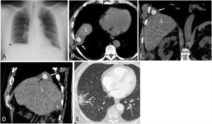 (A) Posteroanterior chest radiograph shows a small right basal opacity (asterisk). (B)–(D) Axial (B), coronal (C), and sagittal (D) thoracic CT images (mediastinal window) show a polygonal calcified lesion in the right pleural space (black arrow). Note the small pleural effusion (white arrow). “L” represents the liver. (E) Axial thoracic CT image (lung window) shows inflammatory changes in the right lower lobe (arrows).
